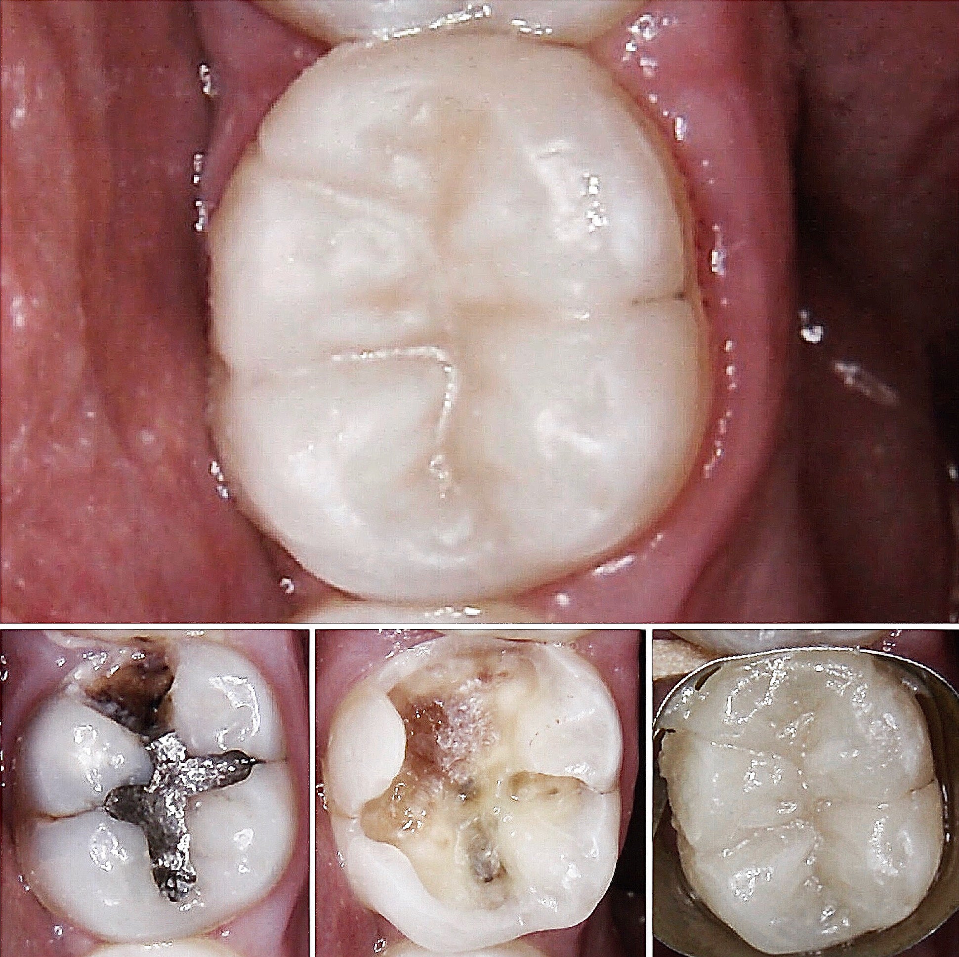 Composite filling result