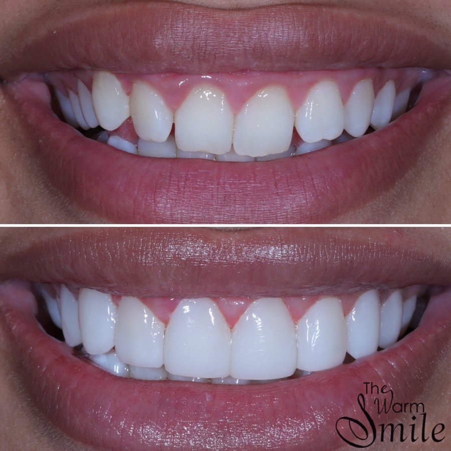 Composite bonding before and after at The Warm Smile - before on top, after below (case 1)
