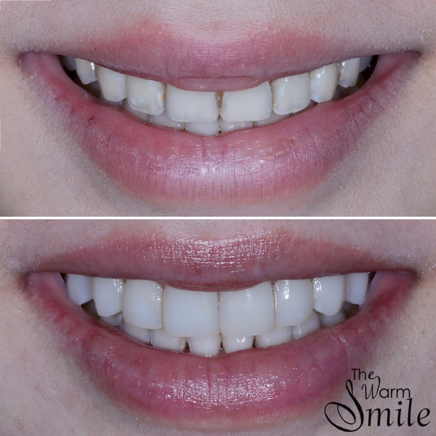 Composite bonding before and after at The Warm Smile - before on top, after below (case 2)