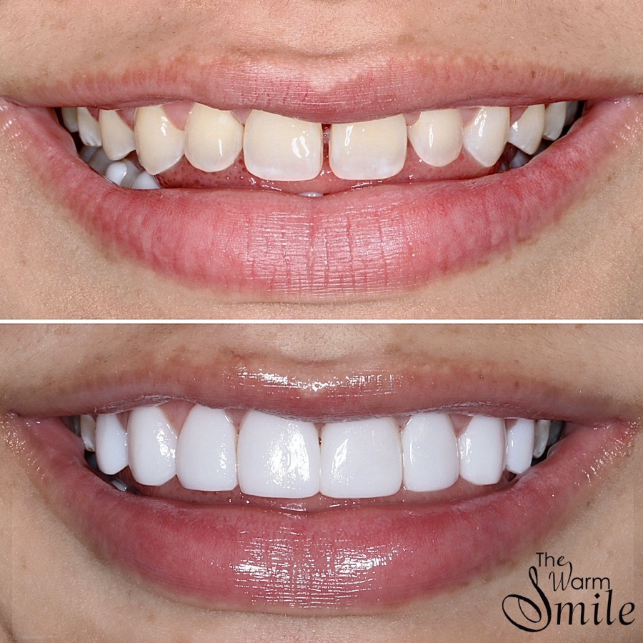 Composite bonding before and after at The Warm Smile - before on top, after below (case 3)