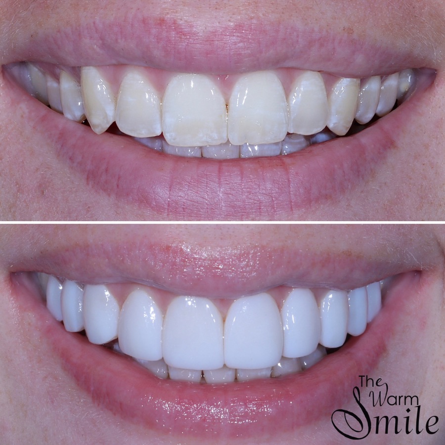 Composite bonding before and after at The Warm Smile - before on top, after below (case 4)