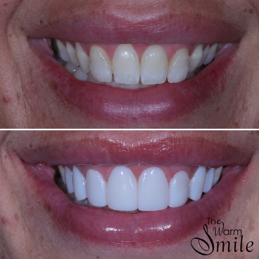 Composite bonding before and after at The Warm Smile - before on top, after below (case 5)