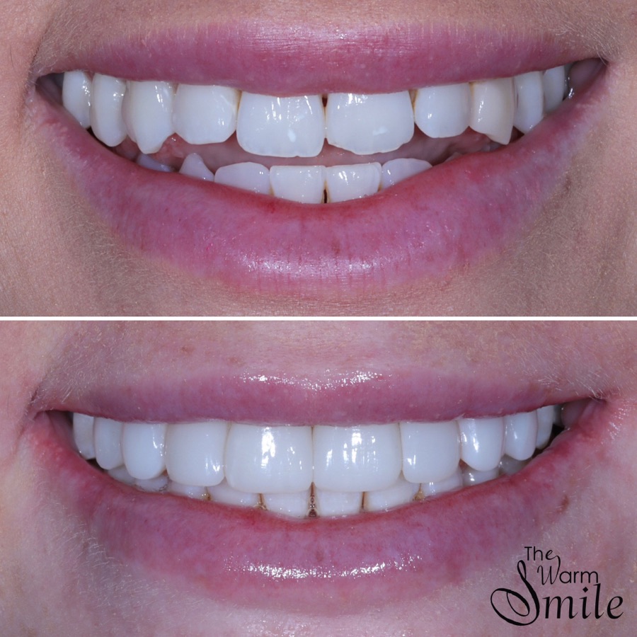 Composite bonding before and after at The Warm Smile - before on top, after below (case 6)