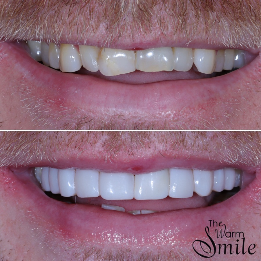 Composite bonding before and after at The Warm Smile - before on top, after below (case 7)