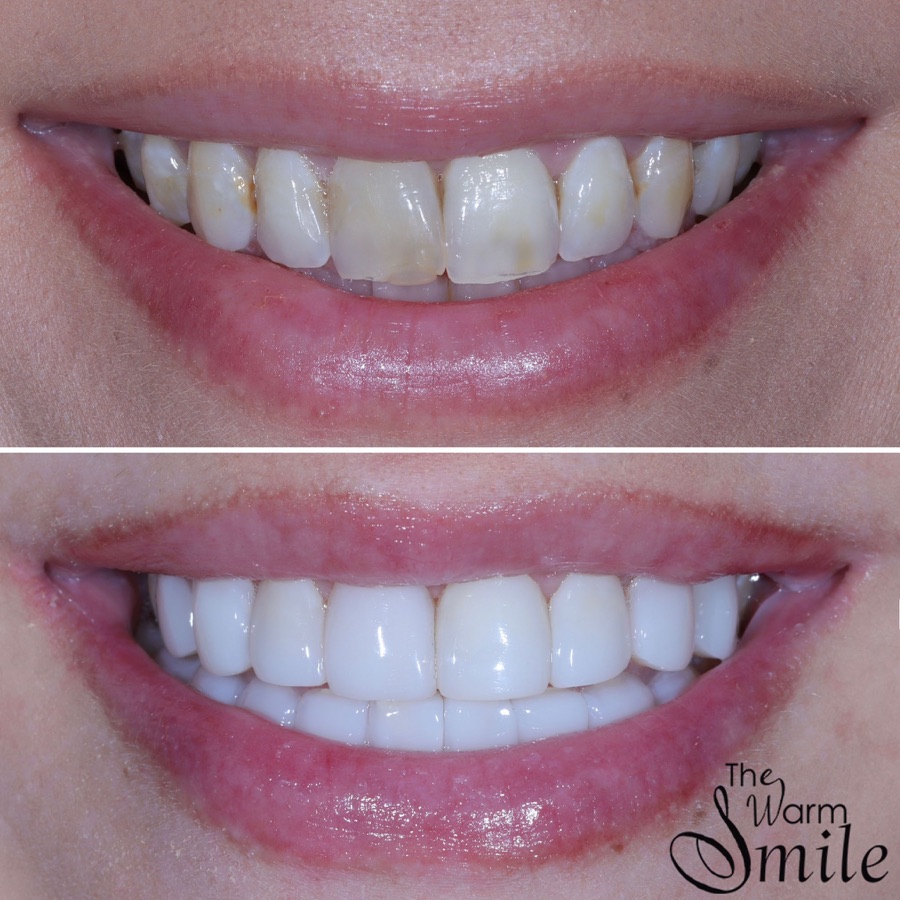 Composite bonding before and after at The Warm Smile - before on top, after below (case 8)