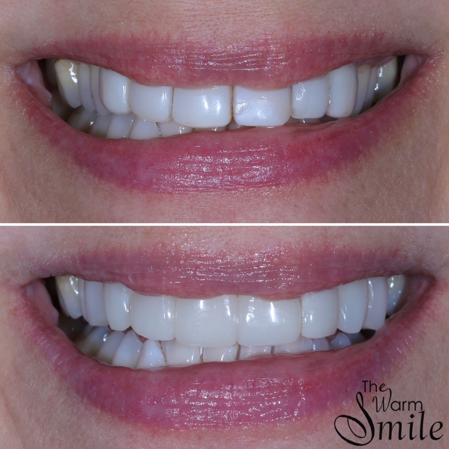 Composite bonding before and after at The Warm Smile - before on top, after below (case 9)