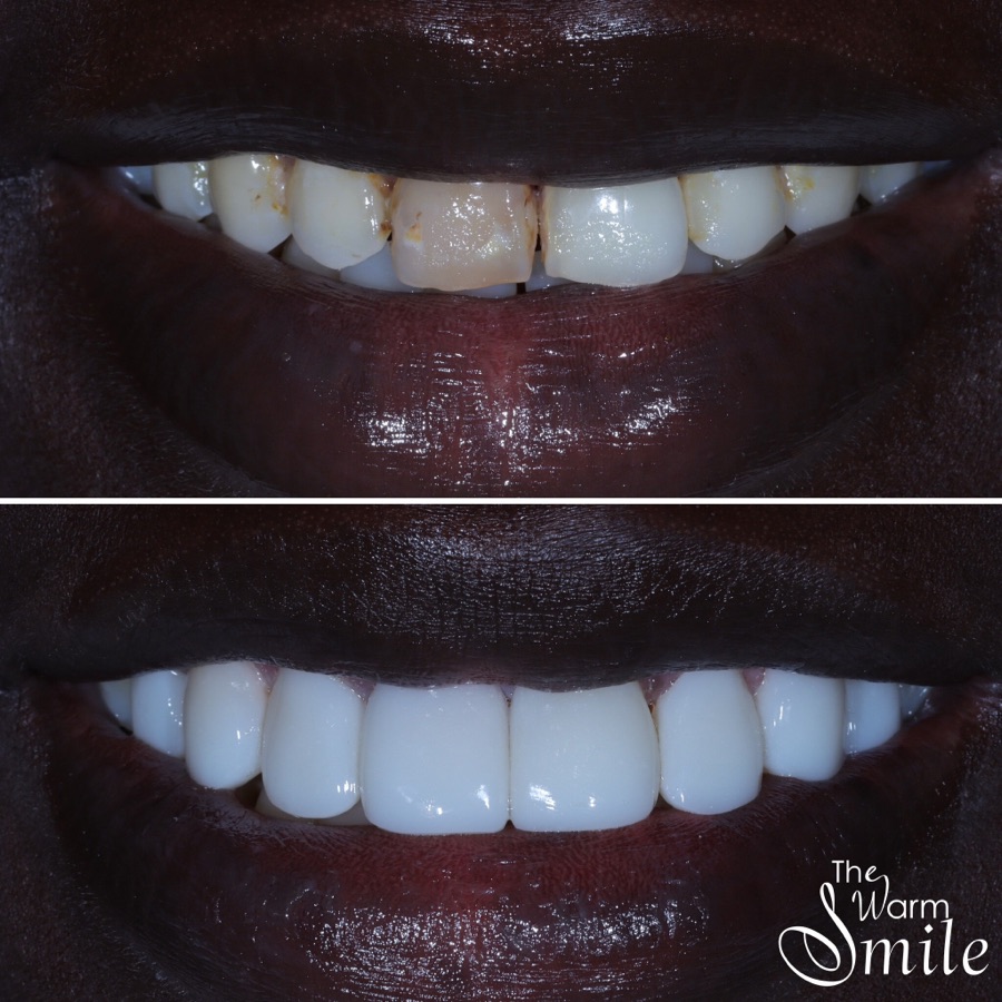 Composite bonding before and after at The Warm Smile - before on top, after below (case 10)
