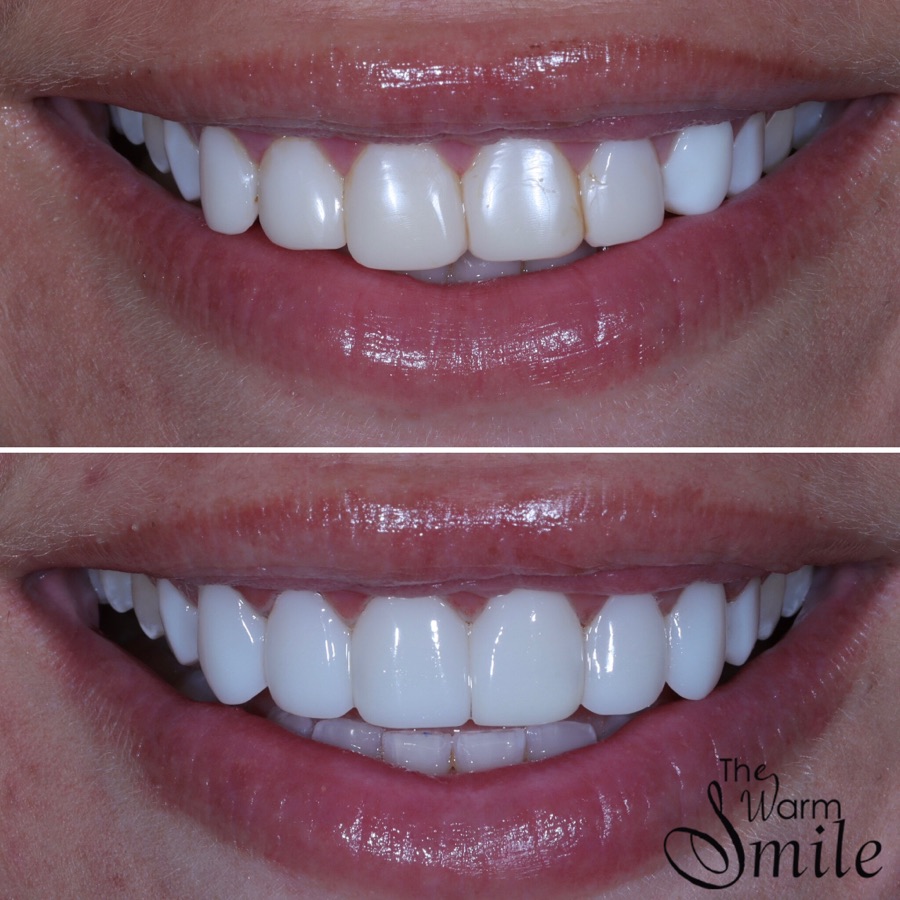 Composite bonding before and after at The Warm Smile - before on top, after below (case 11)