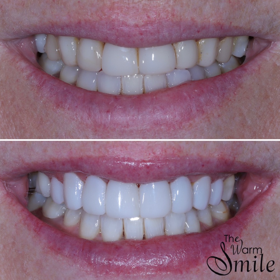 Composite bonding before and after at The Warm Smile - before on top, after below (case 12)