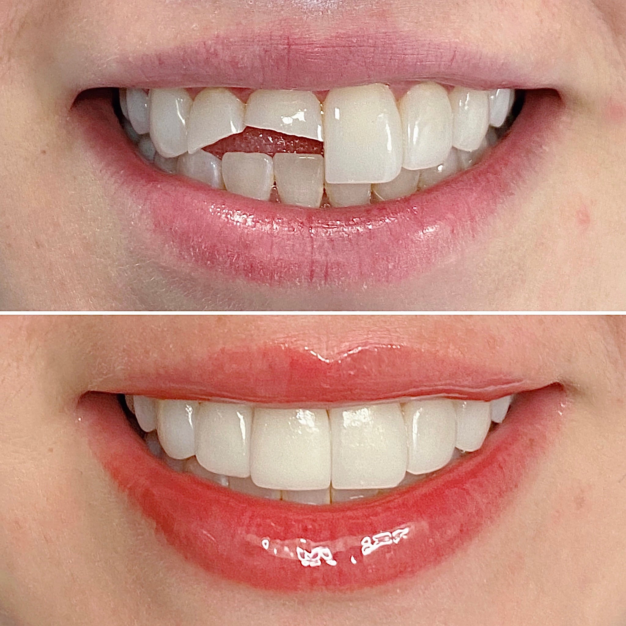Same-day CAD/CAM porcelain crown milling at The Warm Smile