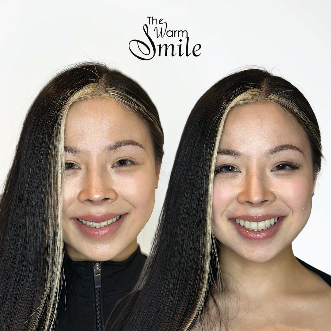 A natural composite bonding smile transformation at The Warm Smile
