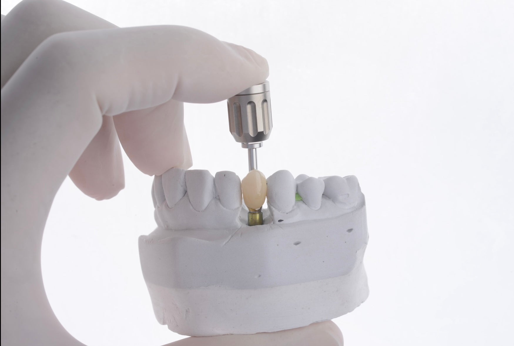 Dental implant treatment at The Warm Smile