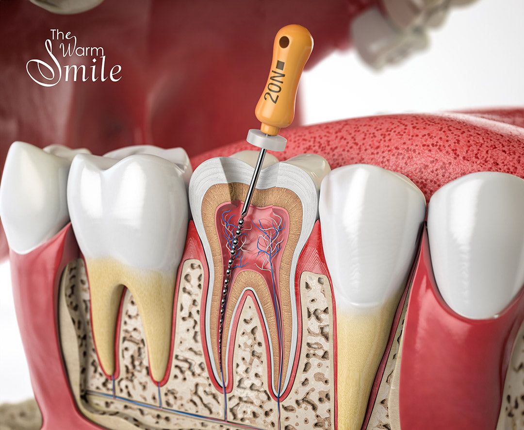 Root canal treatment at The Warm Smile, Melbourne