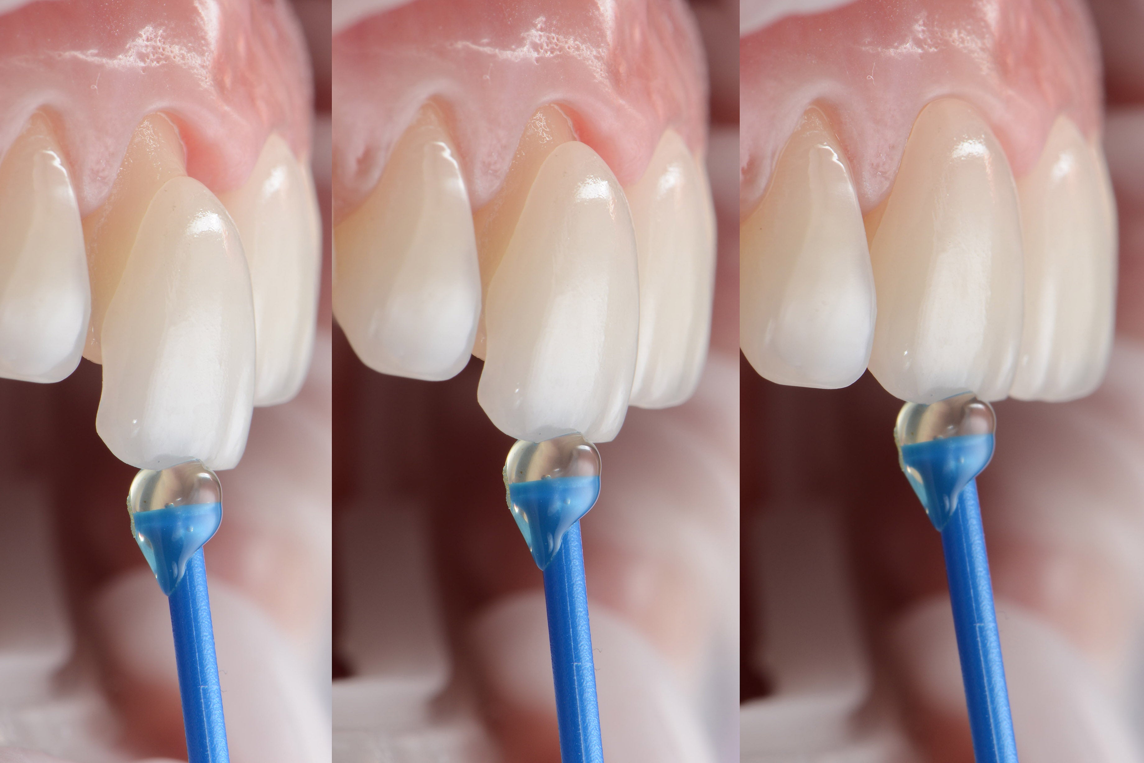 A bright, natural porcelain veneer smile