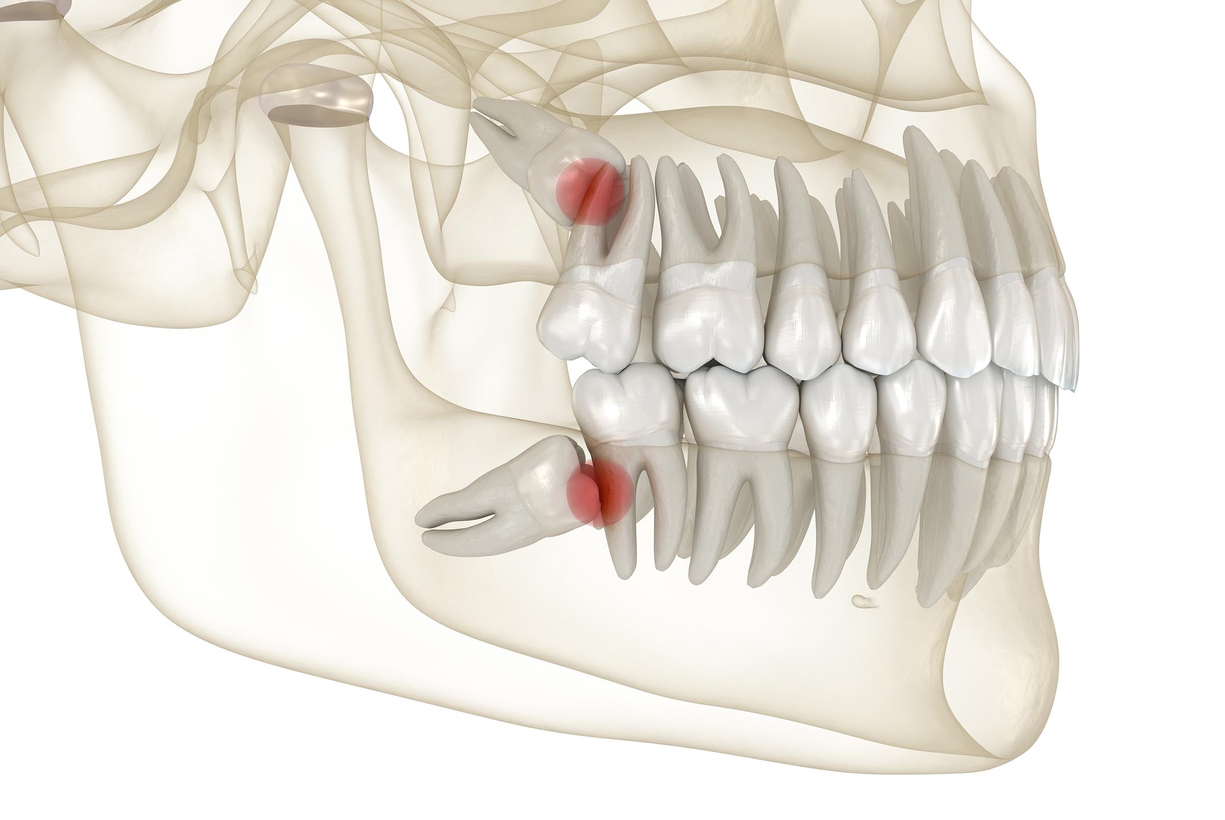 Wisdom teeth consultation at The Warm Smile