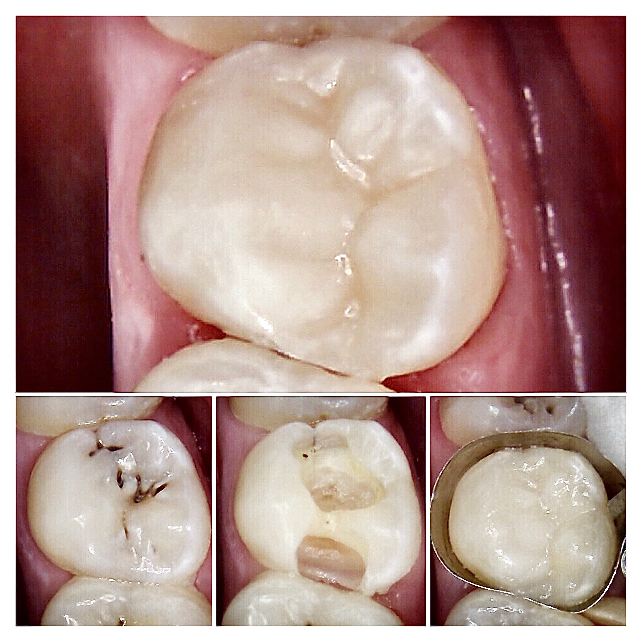 A tooth-coloured composite filling at The Warm Smile
