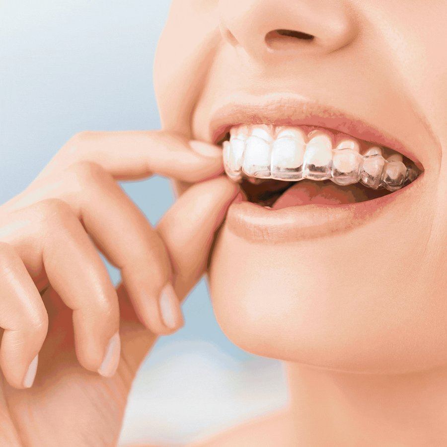 A patient holding her clear aligner