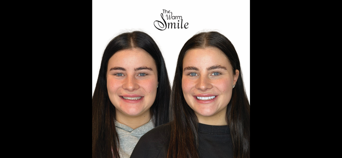 Composite Bonding Melbourne - Natural Smile Enhancement Without Veneers